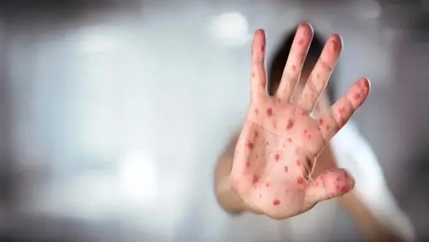 ABD'de Kızamık Alarmı! Vaka Sayısı 500'ü Aştı!